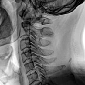 Servikal Omurga — GARION intraoperatif floroskopik görüntü