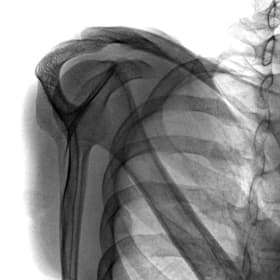 Omuz — GARION intraoperatif floroskopik görüntü