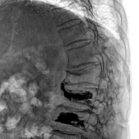 Omurga — Pedikül Vidaları — GARION intraoperatif floroskopik görüntü