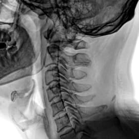 Servikal Omurga — GARION+ intraoperatif floroskopik görüntü