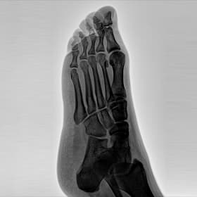 Ayak — GARION+ intraoperatif floroskopik görüntü