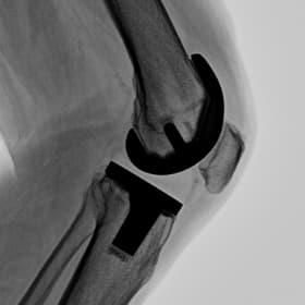Diz — İmplant — GARION+ intraoperatif floroskopik görüntü
