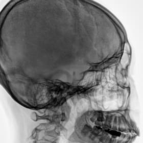 Kafatası — GARION+ intraoperatif floroskopik görüntü