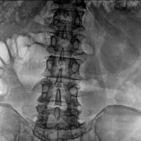 Omurga — Pedikül Vidaları — GARION+ intraoperatif floroskopik görüntü