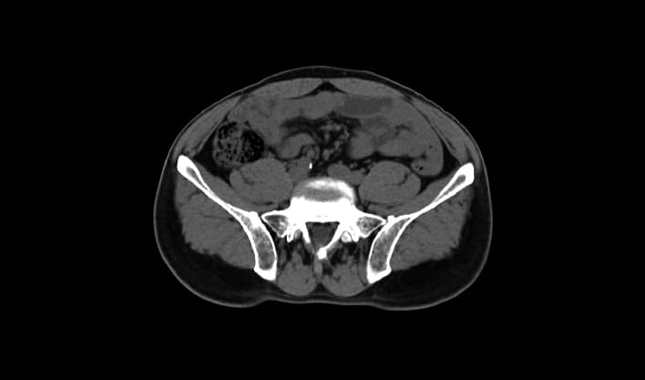 Pelvis aksiyel BT görüntüsü