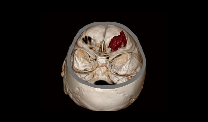 Beyin 3D VRT — TurboTom 1S PRO klinik BT görüntüsü