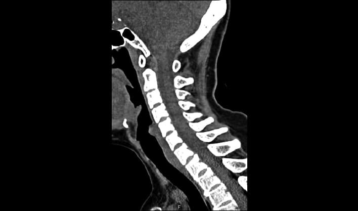 Servikal Omurga — TurboTom 1S PRO klinik BT görüntüsü