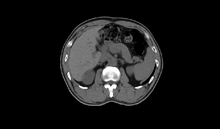 Karaciğer — TurboTom 1S PRO klinik BT görüntüsü