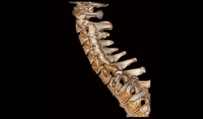 Omurga 3D VRT — TurboTom 1S PRO klinik BT görüntüsü