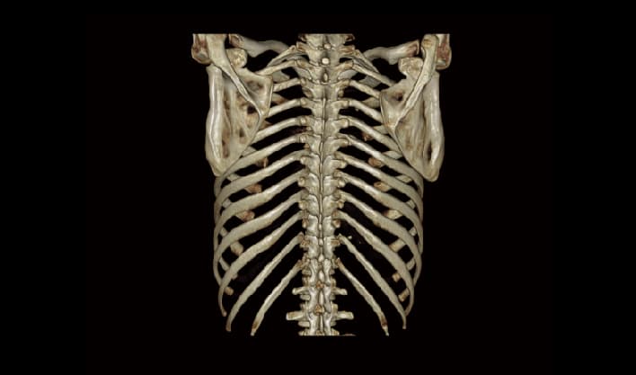 Toraks 3D VRT — TurboTom 1S PRO klinik BT görüntüsü