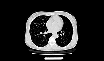 Toraks — TurboTom 3 Serisi klinik BT görüntüsü