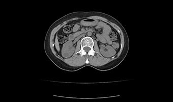 Abdomen — TurboTom 3S klinik BT görüntüsü