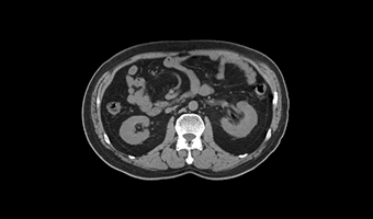 Alt Abdomen — TurboTom 3S klinik BT görüntüsü