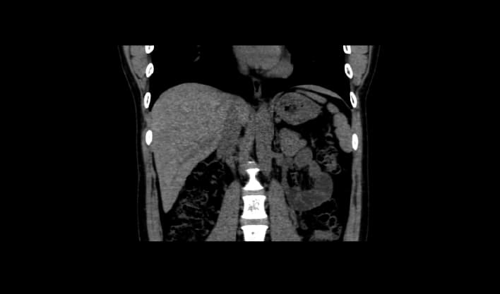 Abdomen — TurboTom 5S klinik BT görüntüsü