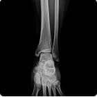 Tibia-Fibula — SG HealthCare Jumong serisi dijital radyografi görüntüsü