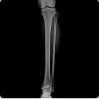 Tibia-Fibula — SG HealthCare Jumong serisi dijital radyografi görüntüsü