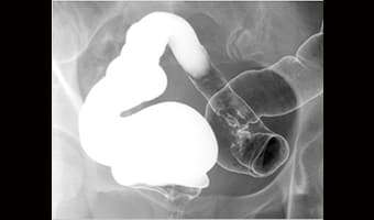 Üst Gastrointestinal Sistem — DRF-5 Serisi klinik floroskopi görüntüsü