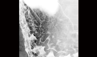 Toraks-Abdomen Vasküler Yapı — DRF-6A klinik floroskopi görüntüsü