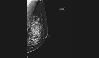 LMLO — Sol Mediolateral Oblik — DM-2 Serisi klinik mamografi görüntüsü