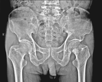 Pelvis / Kalça — AeroRAD mobil DR sistemlerinde uyumlu dedektör sınıfıyla elde edilen klinik görüntü