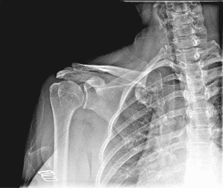 Omuz — Fiksasyon — AeroRAD mobil DR sistemlerinde uyumlu dedektör sınıfıyla elde edilen klinik görüntü
