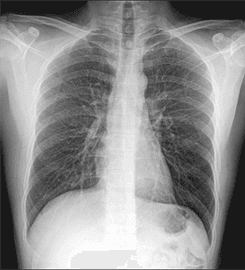 Göğüs (AP) — M50 Serisi klinik dijital radyografi görüntüsü