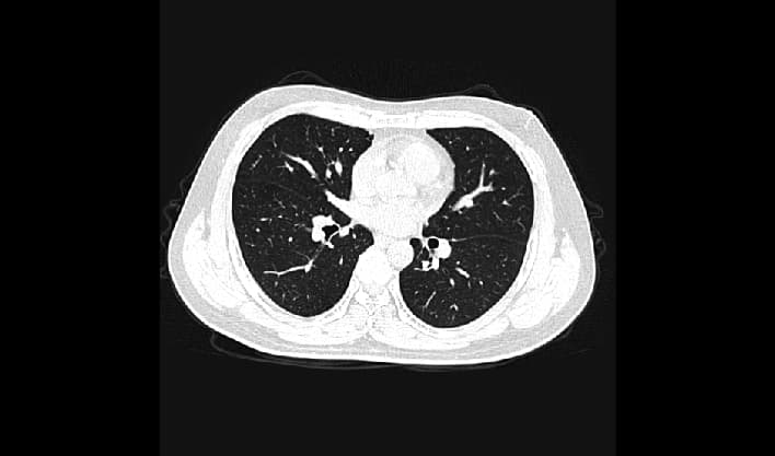 Toraks mediyasten BT görüntüsü