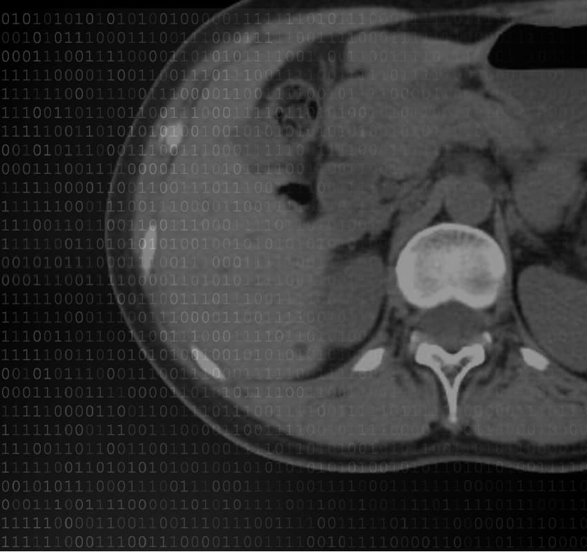 TurboTom 3S HD düşük doz görüntüleme — abdomen BT, dijital veri işleme görseli