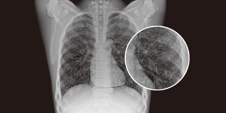 New Oriental 1000FC 100µm göğüs PA radyografisi — akciğer detay büyütmesi