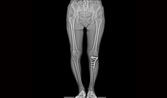 New Oriental 1000LB — Alt Ekstremite radyografisi
