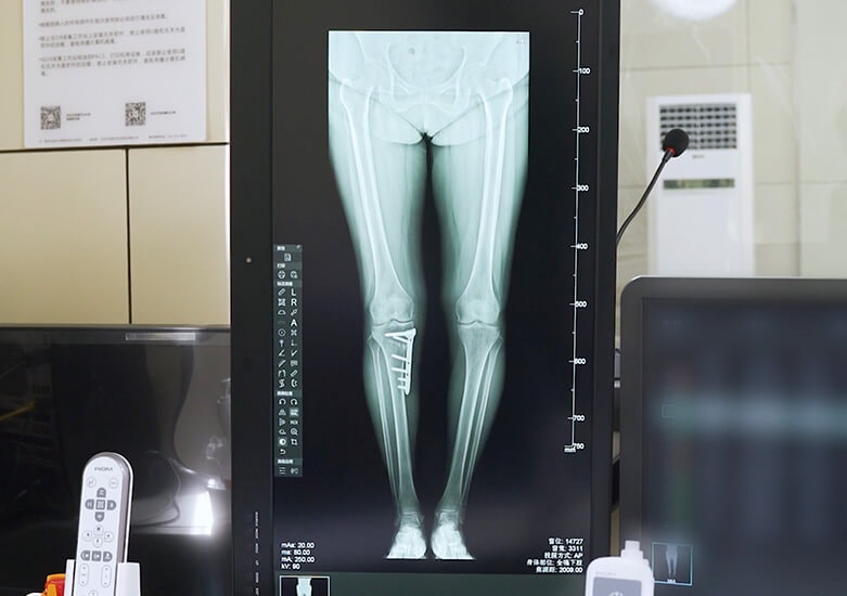 New Oriental 1000LB klinik görüntü — alt ekstremite tam boy AP radyografisi ekranda