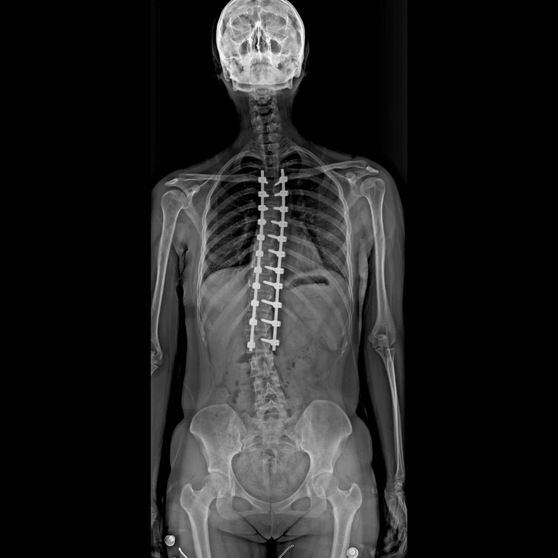 DRF-6A akıllı dinamik birleştirme ile elde edilmiş, cerrahi enstrümantasyon içeren omurga klinik görüntüsü