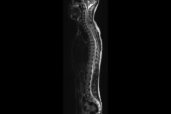 i_Field 1.5T — Omurga Sagittal