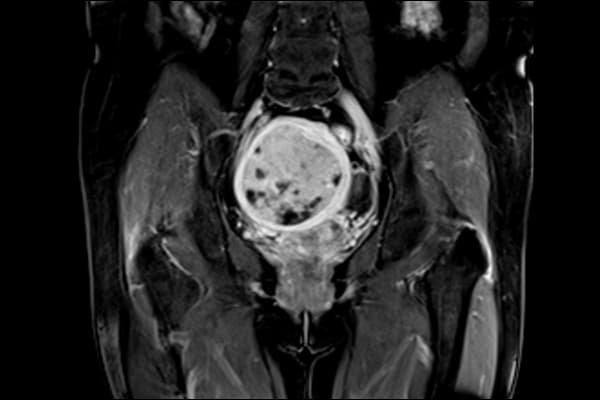 i_Field 1.5T — Pelvis Koronal