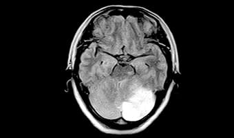 i_Open 0.4T — Beyin Axial T2 — Posterior Fossa