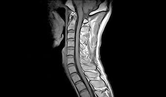 i_Open 0.4T — Servikal Omurga Sagittal