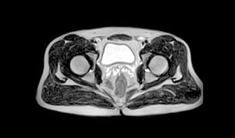 i_Open 0.4T — Kalça Axial — Bilateral