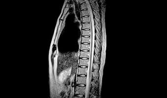 i_Open 0.4T — Torakal Omurga Sagittal