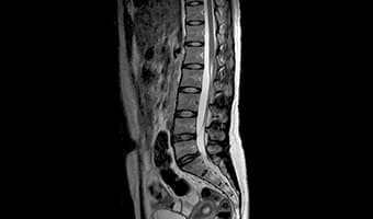 i_Open 0.4T — Lomber Omurga Sagittal