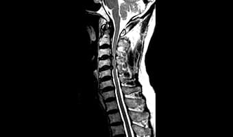 i_Open 0.5T — Servikal Omurga Sagittal T2