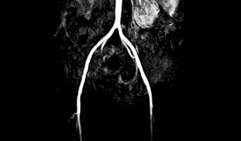 i_Open 0.5T — Aort MRA Koronal — Aortik Bifürkasyon