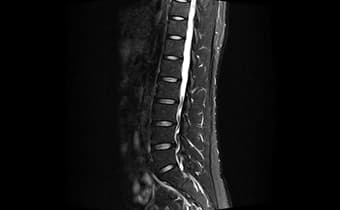 i_Space 1.5T — Omurga T2 Torakolomber Sagittal
