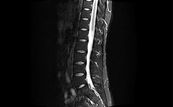 i_Space 1.5T — Omurga STIR Sagittal — Yağ Baskılamalı