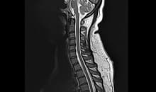 i_Space 1.5T — Servikal Omurga Sagittal