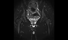 i_Space 1.5T — Pelvis Koronal