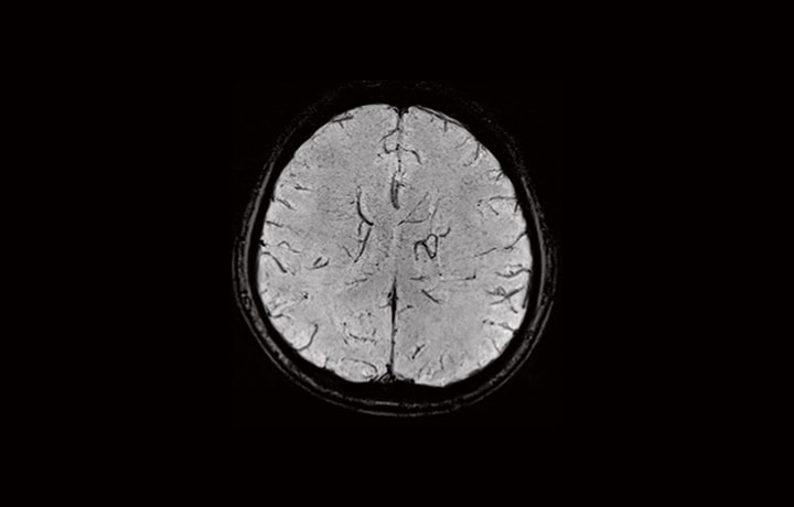 i_Vision 1.5T Brain SWI — 4-8x Hızlanma