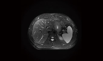 i_Vision 1.5T — Abdominal T2 Fat Saturation