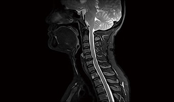 i_Vision 1.5T — Cervical Spine T2 DIXON