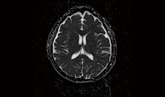 i_Vision 1.5T — Brain ADC