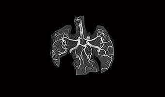 i_Vision 1.5T — Brain MRA
